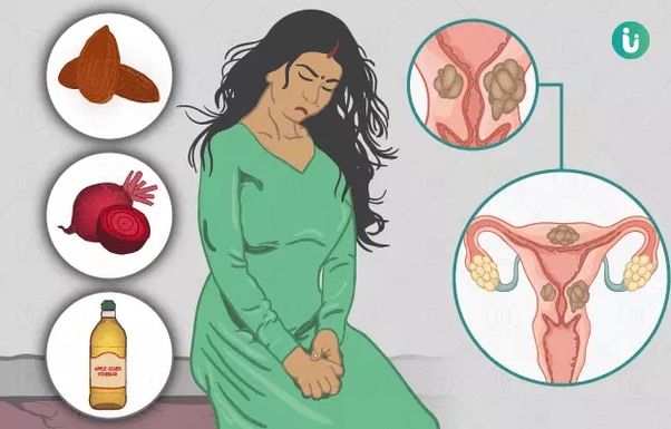 ओवेरियन सिस्ट का घरेलू और मेडिकल उपचार